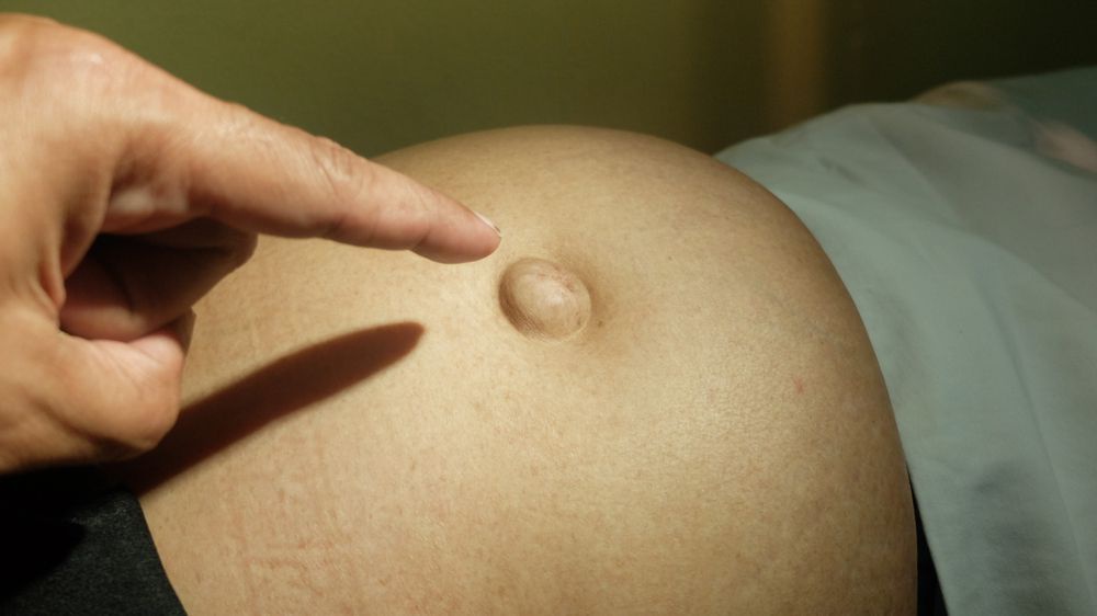 Hérnia umbilical encarcerada