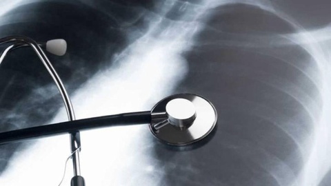 Em 2017, faleceram 290 pessoas por pneumonia na Madeira.