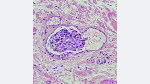 O cancro da mama sobressai com 7.504 novos casos.&nbsp; Foto Shutterstock