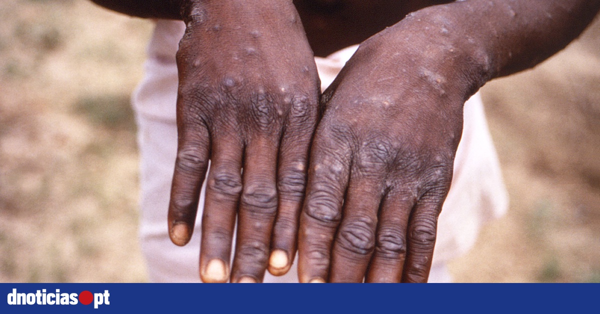 Number of confirmed cases of Monkeypox in Portugal rises to 898 — DNOTICIAS.PT