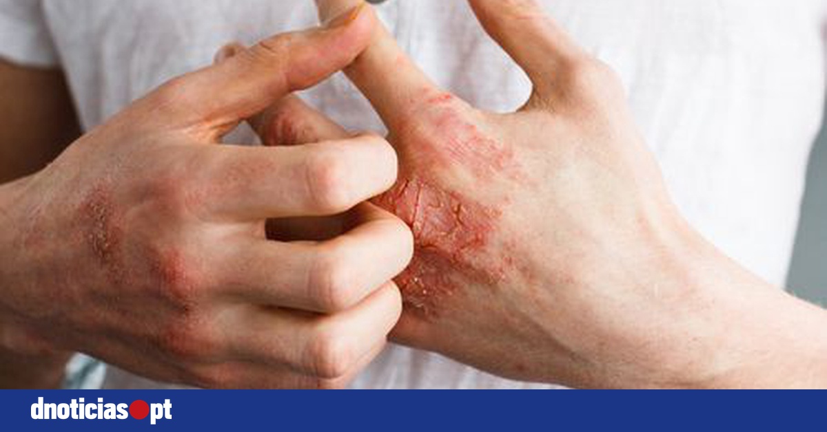 Scientists identify a genetic mutation responsible for psoriasis — DNOTICIAS.PT